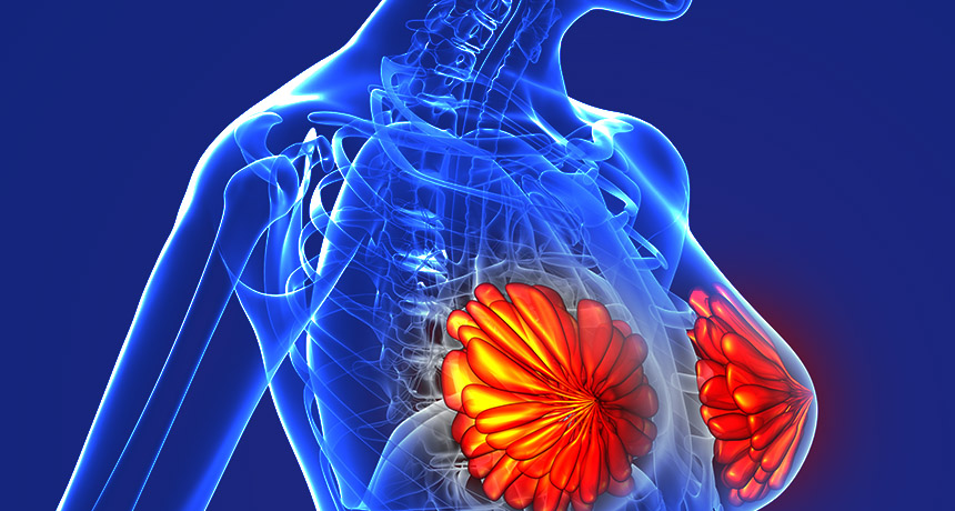 Cáncer de pulmón